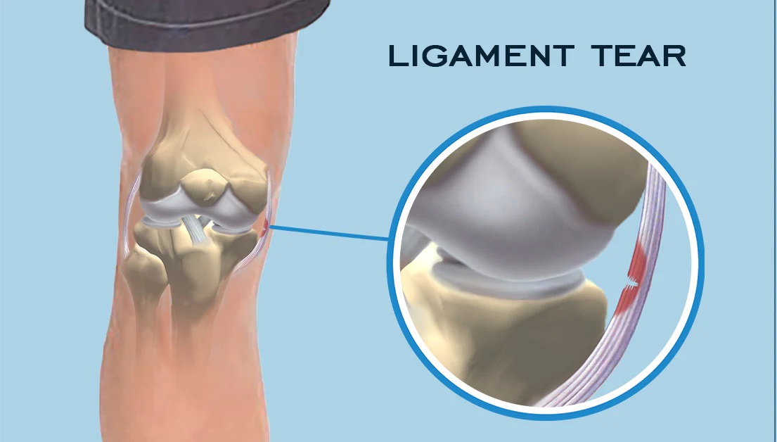 MCL Injury: Medial Collateral Ligament (MCL) Tear & Reconstruction, Knee  Surgeon in Mumbai