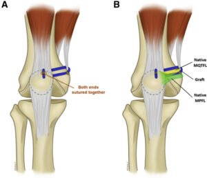 Medial Patellofemoral Ligament Reconstruction - Dr. Rahul Bade