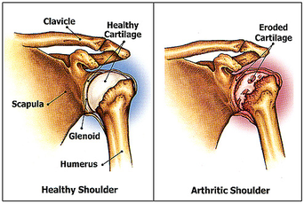 Shoulder Dislocation Treatment Doctors In Pune
