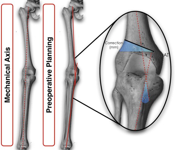 Distal Femoral Osteotomy Dr Rahul Bade