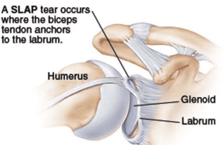 Shoulder SLAP Lesion Doctor in Pune, India