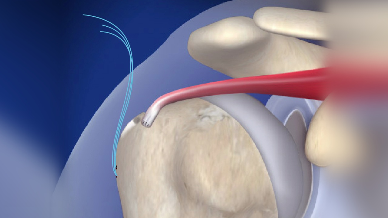 Arthroscopic Rotator Cuff Repair in Pune India