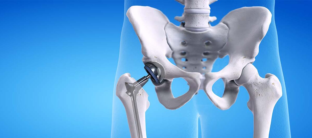 Hip replacement surgeon in baner