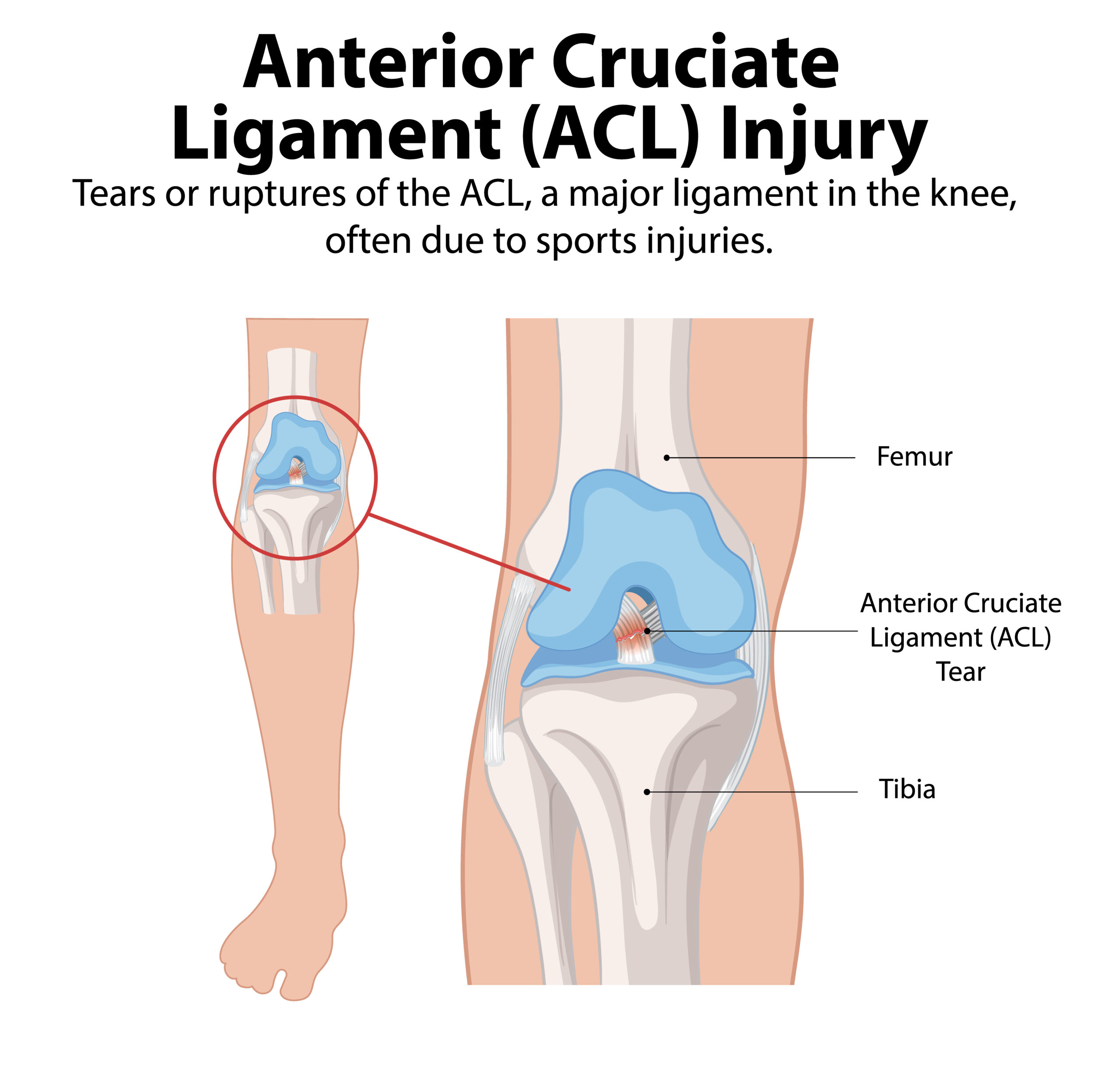 acl surgeon in pune